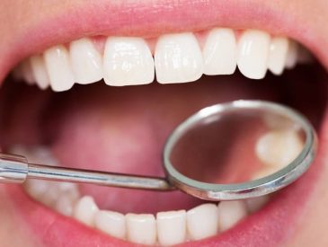 Five Signs You Need to Get a Tooth Filling