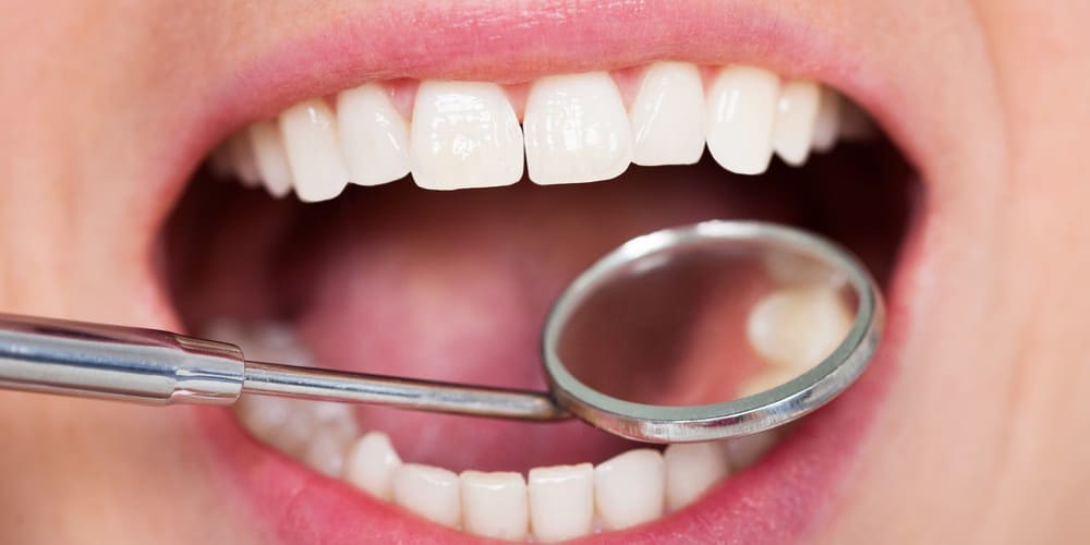 Five Signs You Need to Get a Tooth Filling